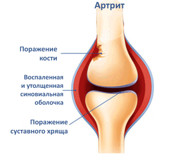 Красный сустав. Ревматоидный артрит коленного сустава. Ревматоидный артрит колена.