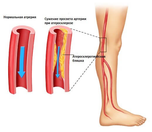 Шишки на ноге ниже колена на кости и в подколенной области